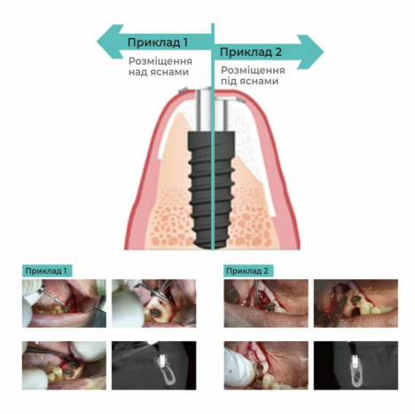 Гвинт-заглушка